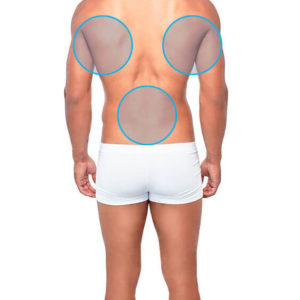 Modelo masculino de espaldas con círculos azules en las lumbares y dorsales para indicar dónde se realiza la depilación láser masculina de espalda