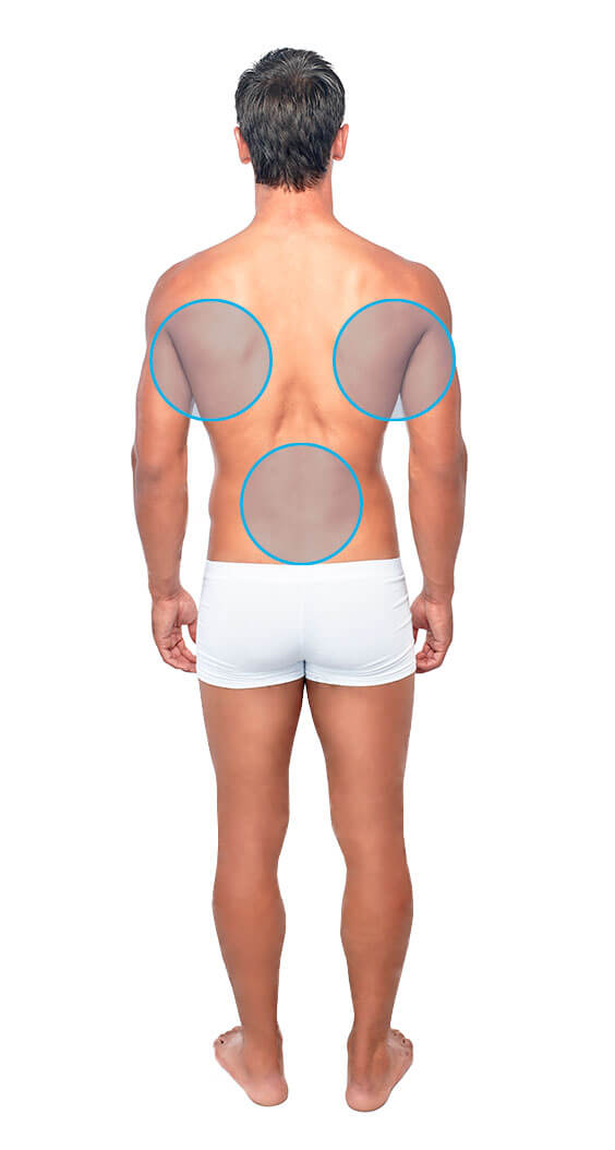 Modelo masculino de espaldas con círculos azules en las lumbares y dorsales para indicar dónde se realiza la depilación láser masculina de espalda
