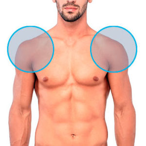 Modelo con dos círculos en los hombros indicando la zona de depilación láser masculina